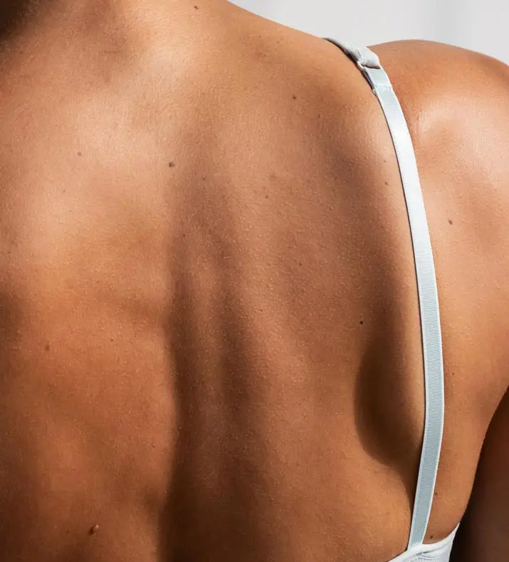 Paul Wilson Aesthetics - Bra Line Back Lift Post Op Recovery