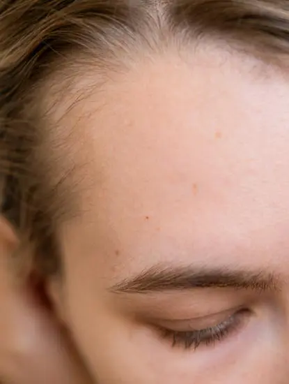 Paul Wilson Aesthetics - Hairline Lowering Benefits 1