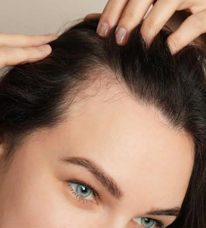 Paul Wilson Aesthetics - Hairline Lowering Post Op Recovery