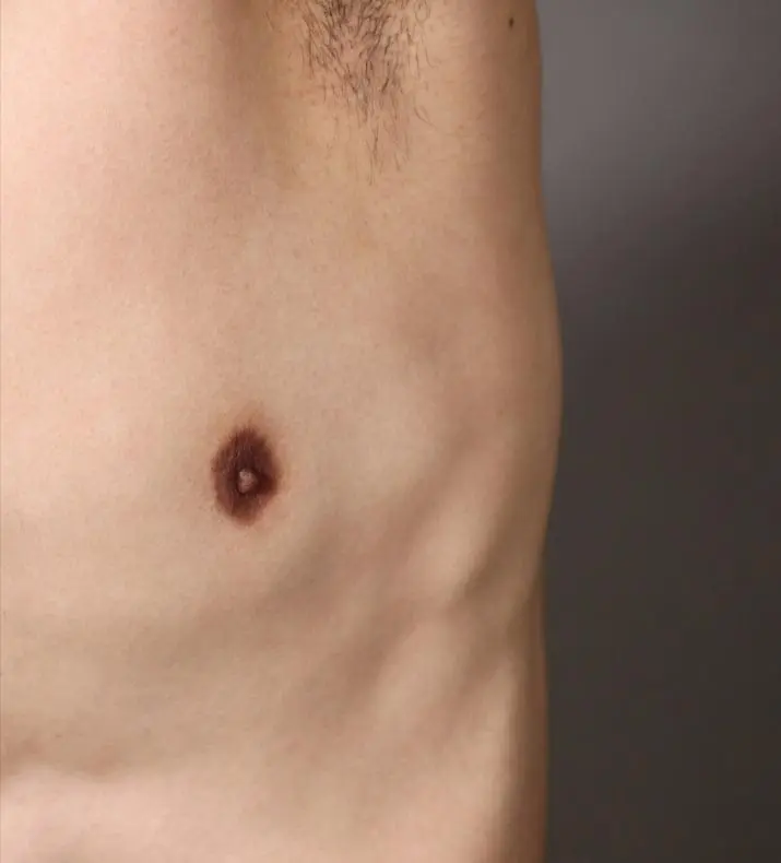 Paul Wilson Aesthetics - Male Breast Reduction Post Op Recovery