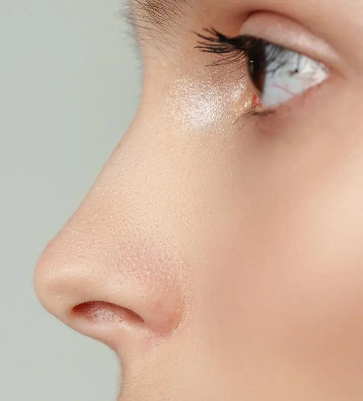 Paul Wilson Aesthetics - Secondary Rhinoplasty Post Op Recovery