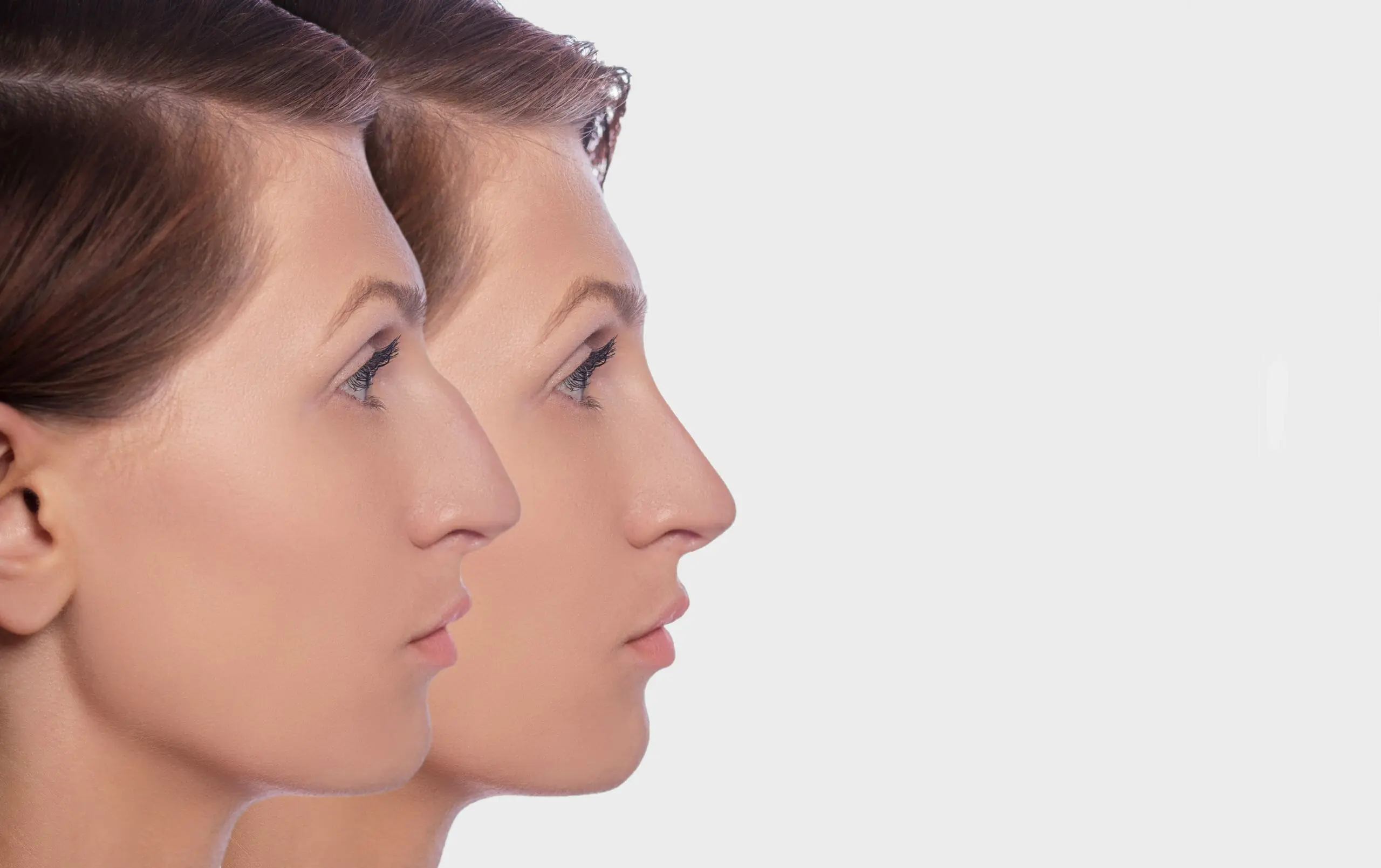 Rhinoplasty before and after female