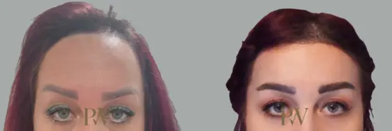 Paul Wilson - Hairline Lowering (Foreheadplasty) Patient Image 1