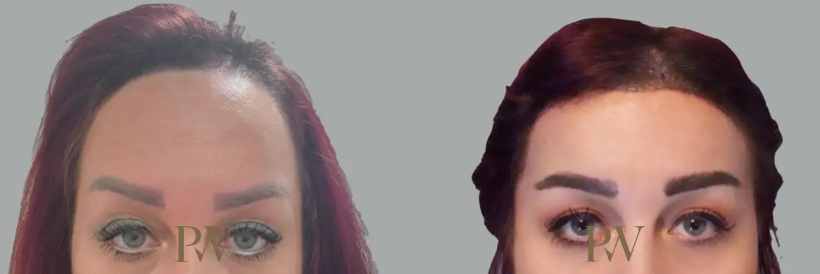 Paul Wilson - Hairline Lowering (Foreheadplasty) Patient Image 1