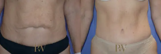 Paul Wilson - Abdominoplasty - Tummy Tuck Patient Image 1