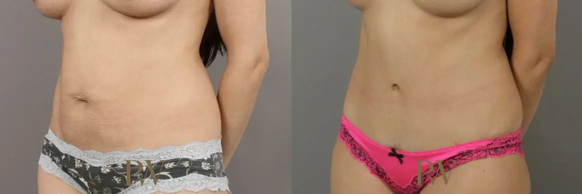 Paul Wilson - Abdominoplasty - Tummy Tuck Patient Image 10