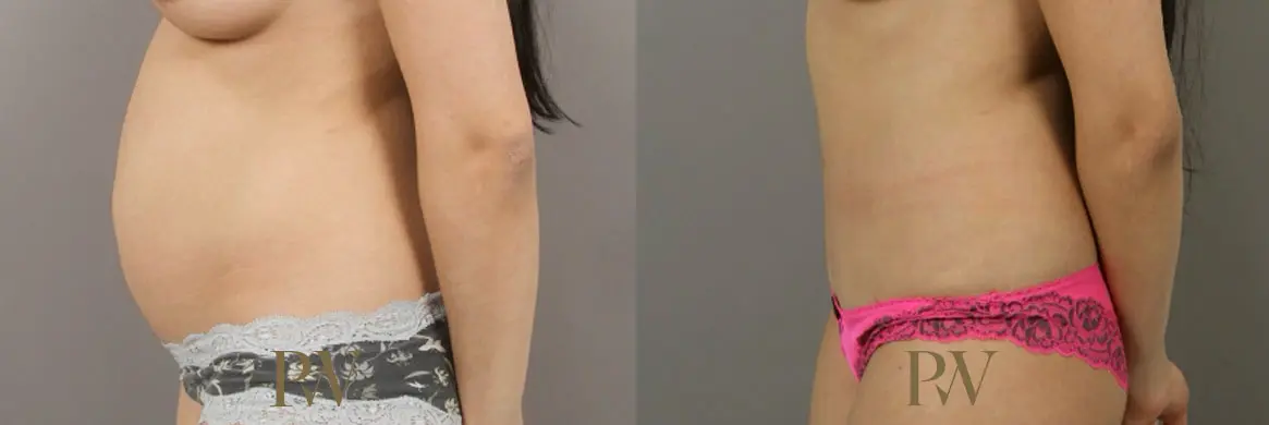 Paul Wilson - Abdominoplasty - Tummy Tuck Patient Image 11