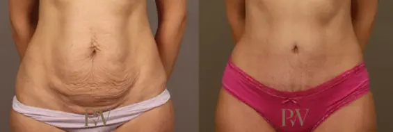 Paul Wilson - Abdominoplasty - Tummy Tuck Patient Image 13