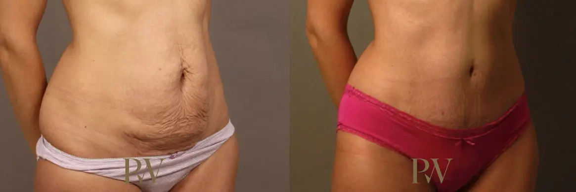 Paul Wilson - Abdominoplasty - Tummy Tuck Patient Image 14