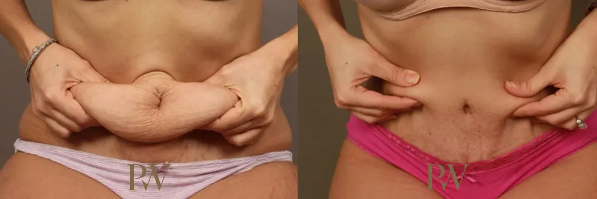 Paul Wilson - Abdominoplasty - Tummy Tuck Patient Image 15