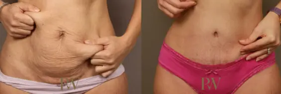 Paul Wilson - Abdominoplasty - Tummy Tuck Patient Image 16