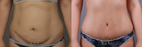Paul Wilson - Abdominoplasty - Tummy Tuck Patient Image 17