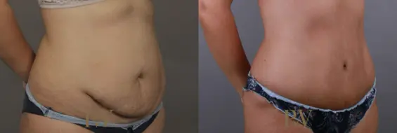Paul Wilson - Abdominoplasty - Tummy Tuck Patient Image 18