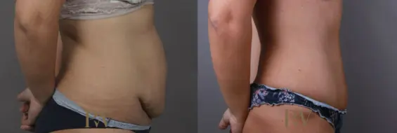 Paul Wilson - Abdominoplasty - Tummy Tuck Patient Image 19