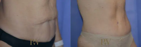 Paul Wilson - Abdominoplasty - Tummy Tuck Patient Image 2