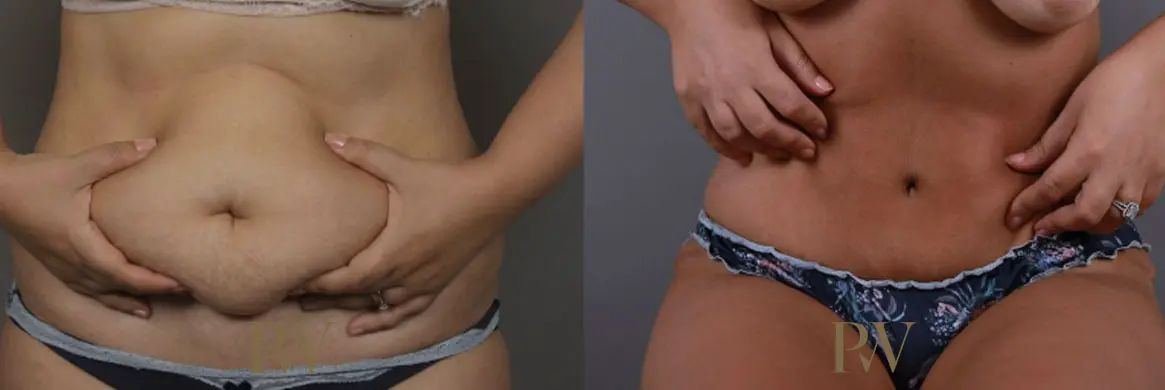 Paul Wilson - Abdominoplasty - Tummy Tuck Patient Image 20