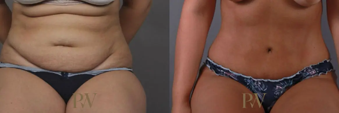 Paul Wilson - Abdominoplasty - Tummy Tuck Patient Image 21