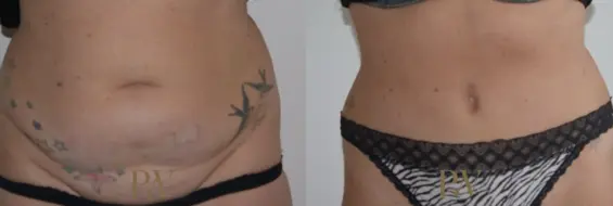 Paul Wilson - Abdominoplasty - Tummy Tuck Patient Image 22