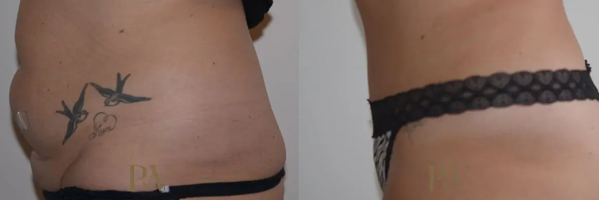 Paul Wilson - Abdominoplasty - Tummy Tuck Patient Image 23