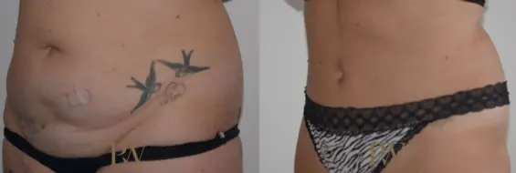 Paul Wilson - Abdominoplasty - Tummy Tuck Patient Image 24