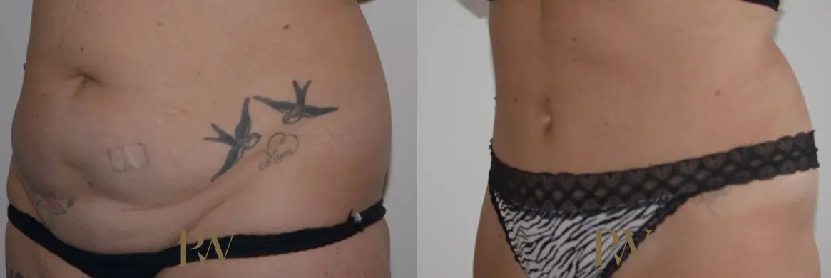 Paul Wilson - Abdominoplasty - Tummy Tuck Patient Image 24