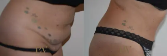 Paul Wilson - Abdominoplasty - Tummy Tuck Patient Image 25
