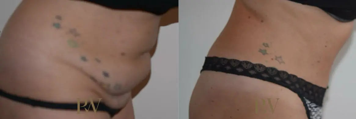 Paul Wilson - Abdominoplasty - Tummy Tuck Patient Image 25