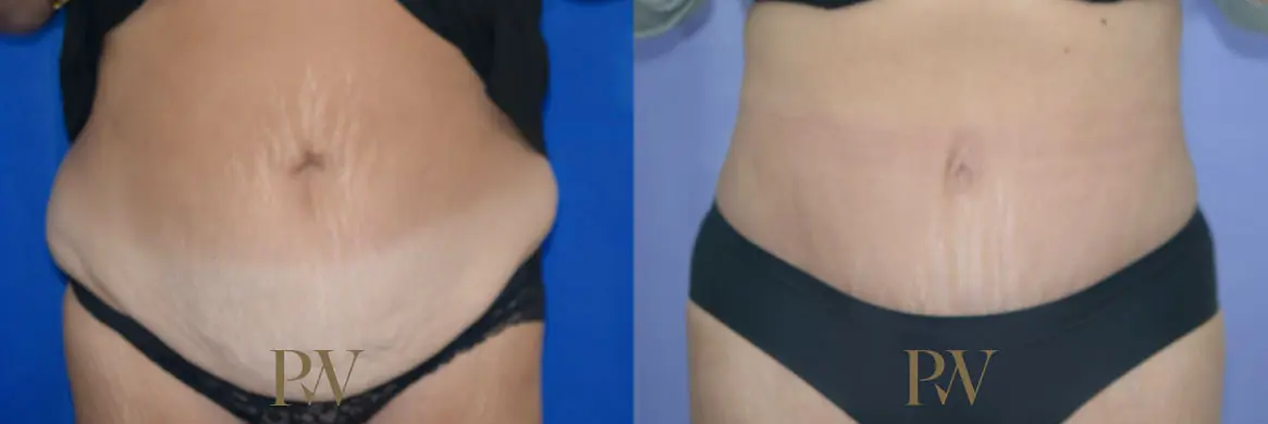 Paul Wilson - Abdominoplasty - Tummy Tuck Patient Image 26