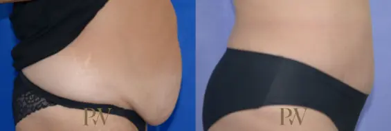 Paul Wilson - Abdominoplasty - Tummy Tuck Patient Image 28