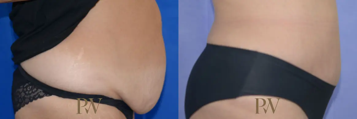 Paul Wilson - Abdominoplasty - Tummy Tuck Patient Image 28