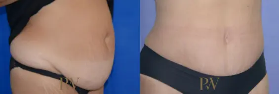 Paul Wilson - Abdominoplasty - Tummy Tuck Patient Image 29