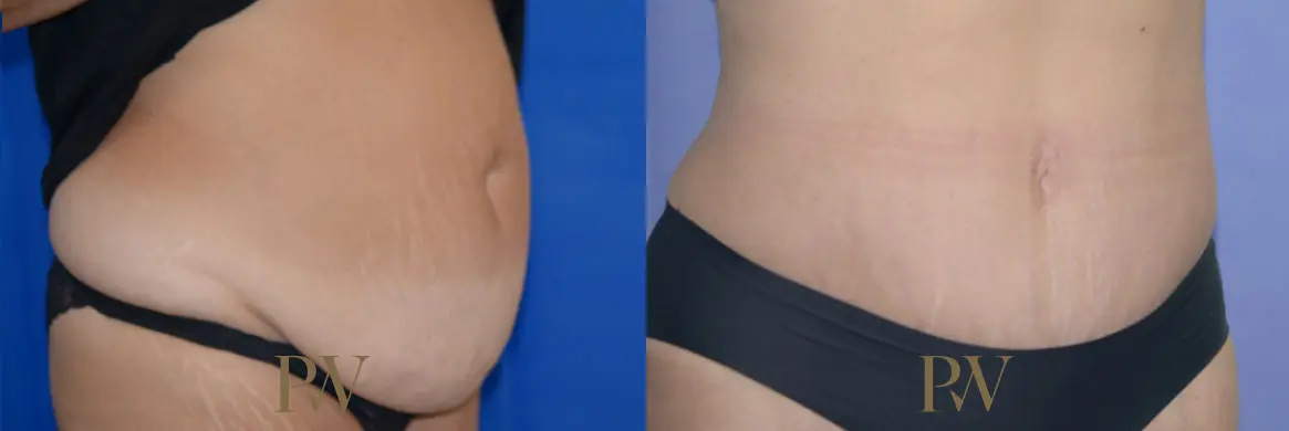 Paul Wilson - Abdominoplasty - Tummy Tuck Patient Image 29
