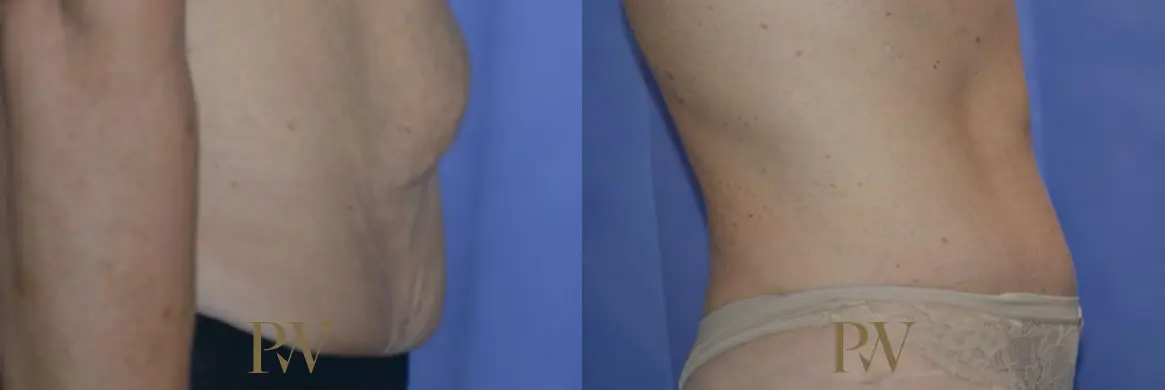 Paul Wilson - Abdominoplasty - Tummy Tuck Patient Image 3