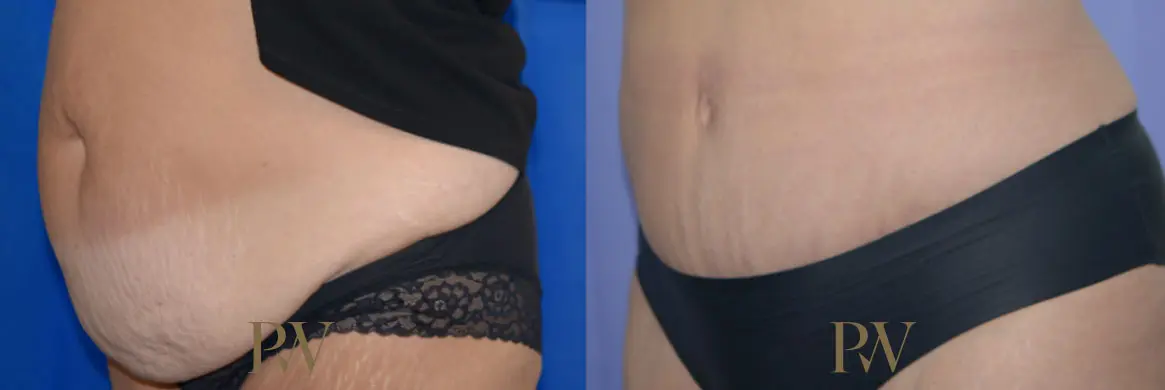 Paul Wilson - Abdominoplasty - Tummy Tuck Patient Image 30