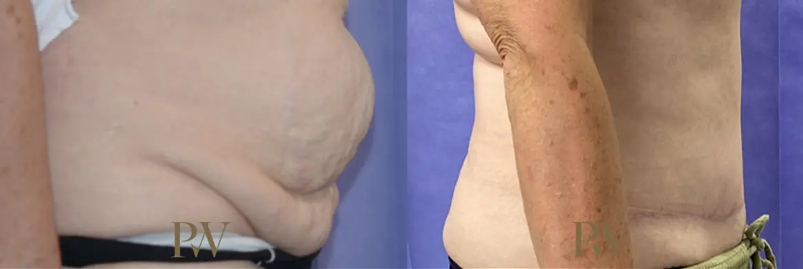 Paul Wilson - Abdominoplasty - Tummy Tuck Patient Image 31