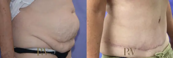 Paul Wilson - Abdominoplasty - Tummy Tuck Patient Image 32