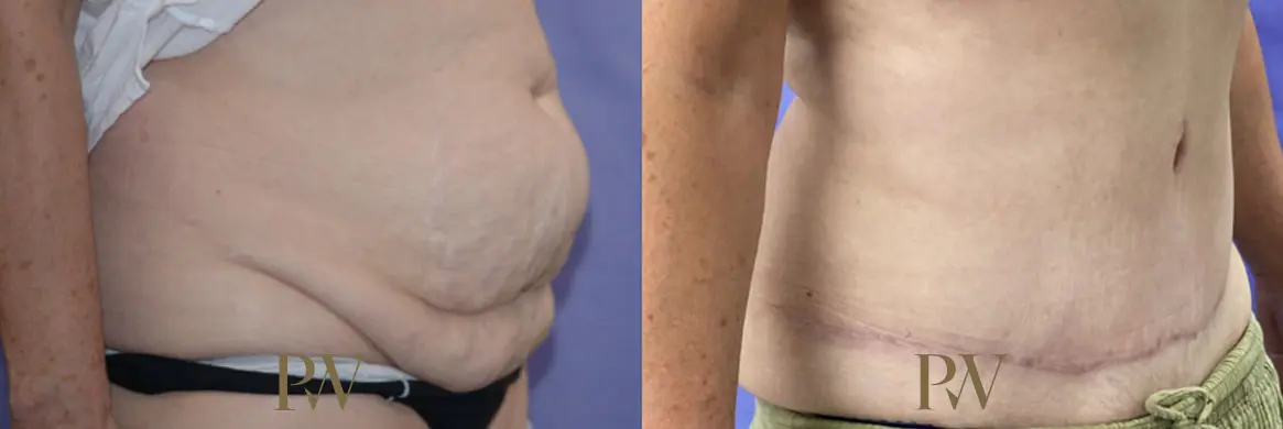 Paul Wilson - Abdominoplasty - Tummy Tuck Patient Image 32