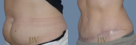 Paul Wilson - Abdominoplasty - Tummy Tuck Patient Image 33