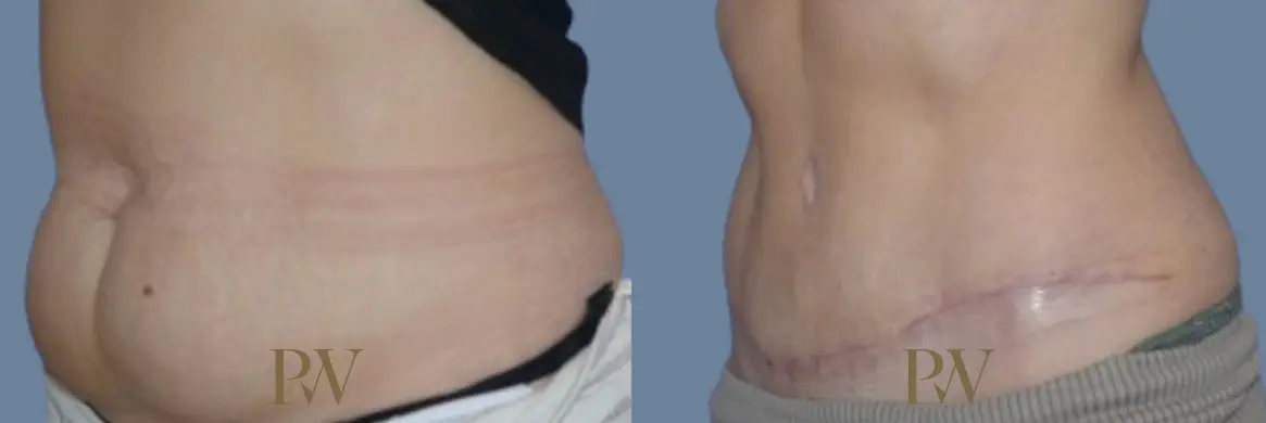 Paul Wilson - Abdominoplasty - Tummy Tuck Patient Image 33