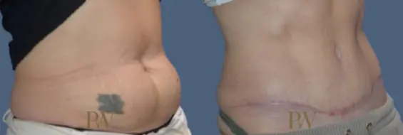 Paul Wilson - Abdominoplasty - Tummy Tuck Patient Image 34