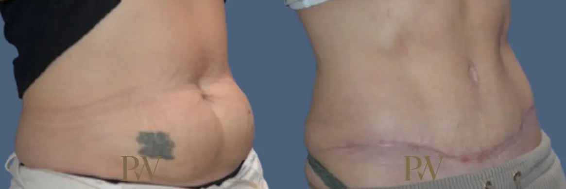 Paul Wilson - Abdominoplasty - Tummy Tuck Patient Image 34