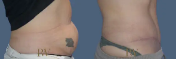 Paul Wilson - Abdominoplasty - Tummy Tuck Patient Image 35