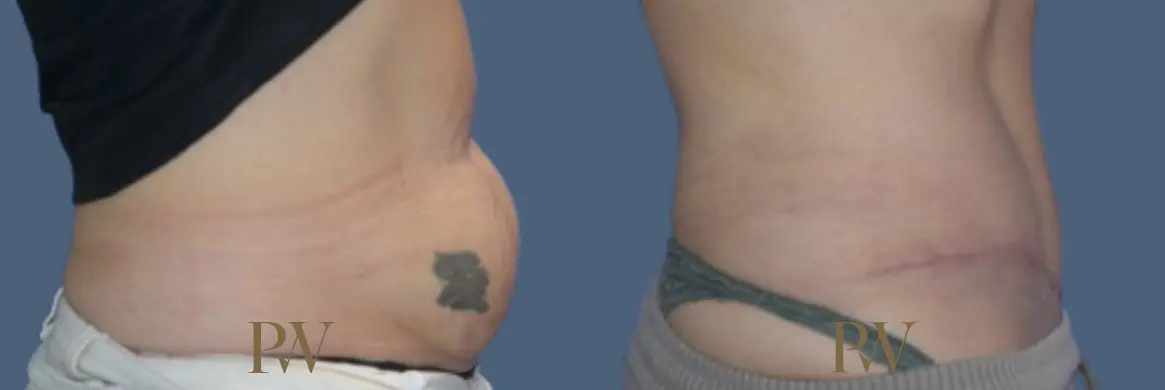 Paul Wilson - Abdominoplasty - Tummy Tuck Patient Image 35