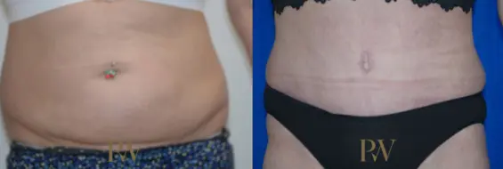 Paul Wilson - Abdominoplasty - Tummy Tuck Patient Image 36