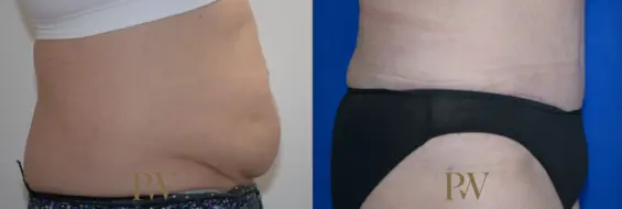 Paul Wilson - Abdominoplasty - Tummy Tuck Patient Image 37