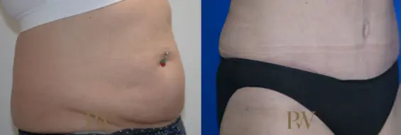 Paul Wilson - Abdominoplasty - Tummy Tuck Patient Image 38