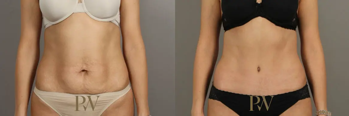 Paul Wilson - Abdominoplasty - Tummy Tuck Patient Image 4