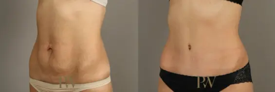 Paul Wilson - Abdominoplasty - Tummy Tuck Patient Image 5