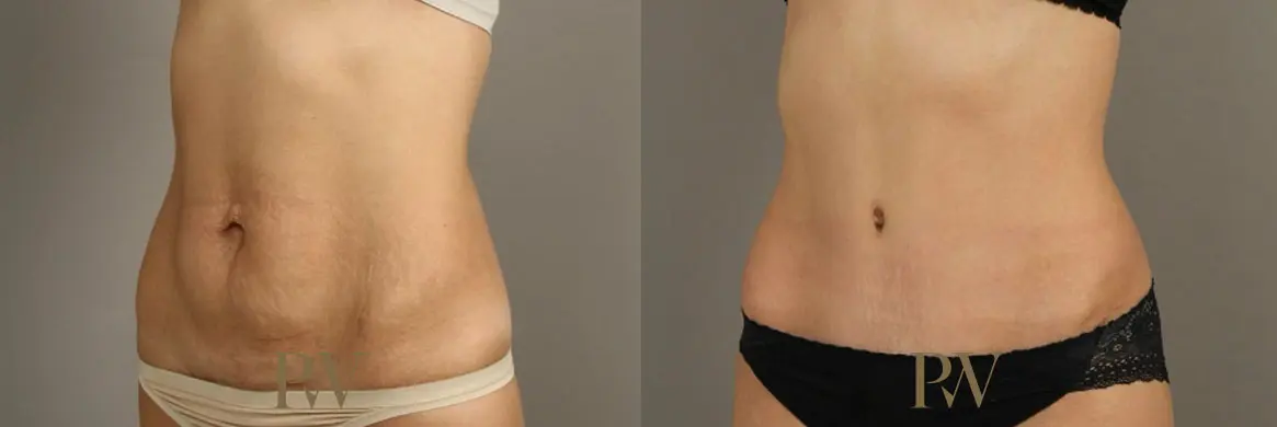Paul Wilson - Abdominoplasty - Tummy Tuck Patient Image 5