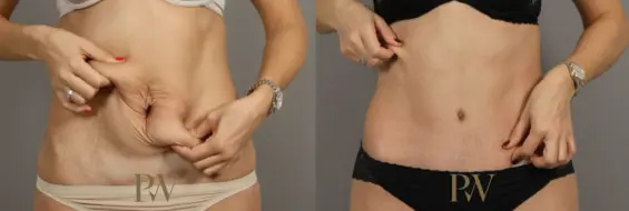 Paul Wilson - Abdominoplasty - Tummy Tuck Patient Image 7